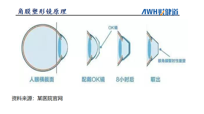 近视OK镜价格表，视界转变之旅，自信与成就感的源泉