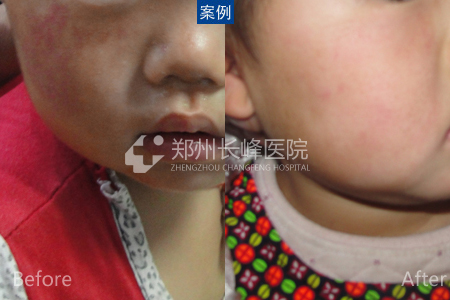 小明胎记治疗之旅，最新技术与友情的力量